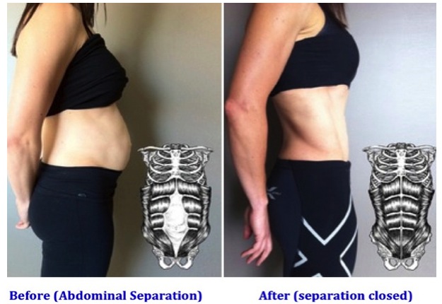 How To Know If You've Got Abdominal Separation - Mouths of Mums