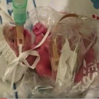 Plastic sandwich bag saves premature baby's life