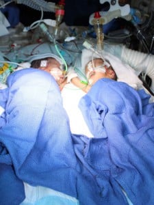 Swiss doctors report separation of 8-day-old conjoined twins