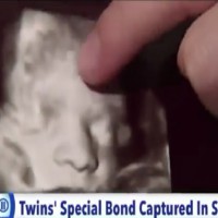 Sonogram shows dying twin holding sister’s hand