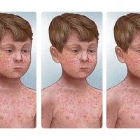 Baby Among Six People Who Have Contracted Measles