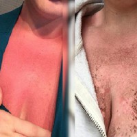Young mums severe sunburn scare after faulty sunscreen