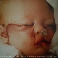 Girl, 11, undergoes incredible facial surgery