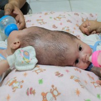 Parents of conjoined twins are praying for miracle surgery