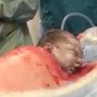 Amazing C-section video goes viral