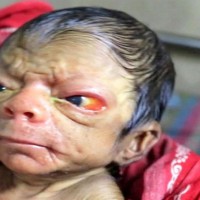 Newborn with rare condition that makes him look like an old man