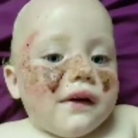 Yet another severe reaction to sunscreen sparks concerns