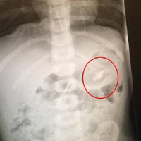 WARNING after Toddler almost died swallowing popular toy