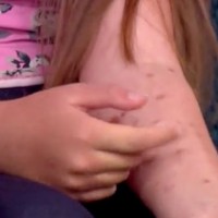 Young girl suffers burns to her arm doing 