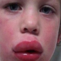 School bullies target kids with allergies