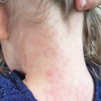 Mum shares warning after popular product caused chemical burns to her young daughter