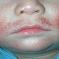 Six of the Most Common Types of Skin Rash