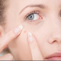 Warning Little-Known Side Effects Of Popular Acne Treatment