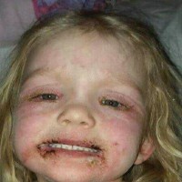 Toddler Suffers Horrific Allergic Reaction to Popular Dress Up Item