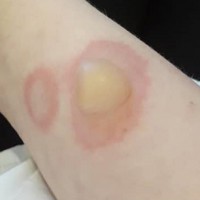 The Dangerous Challenge Leaving Kids With Second-Degree Burns