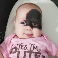 Baby Girl Born With Birthmark Similar to 'Batman Mask'