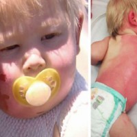 Garden Hose Left Baby Boy With Horrific Second-Degree Burns