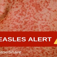 Measles Alert Issued from Children's Hospital