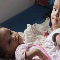 Today Doctor's Will Finally Attempt to Separate Conjoined Twins