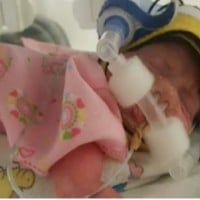 Interesting New Practice for Premature Babies After Birth