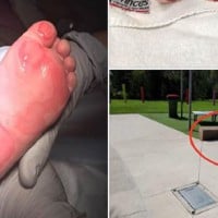 Mum Angry After Toddler Left With Nasty Burns at Water Park