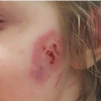 Toddler Left Scarred for Life After Being Bitten 15 Times at Kids Play Centre