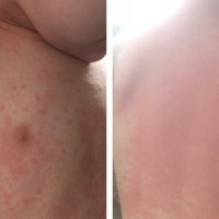 Why You Should NEVER Ignore a Rash on Your Child