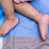 Can I Go To Work With Hand, Foot And Mouth Disease?