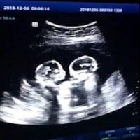 Identical Twins Spotted 'Fighting' in Mother's Womb