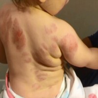 Baby Returns From Daycare With 25 Bite Marks