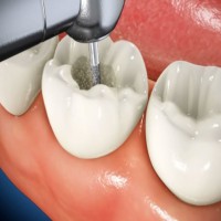 What Is A Root Canal And Why Might You Need One?