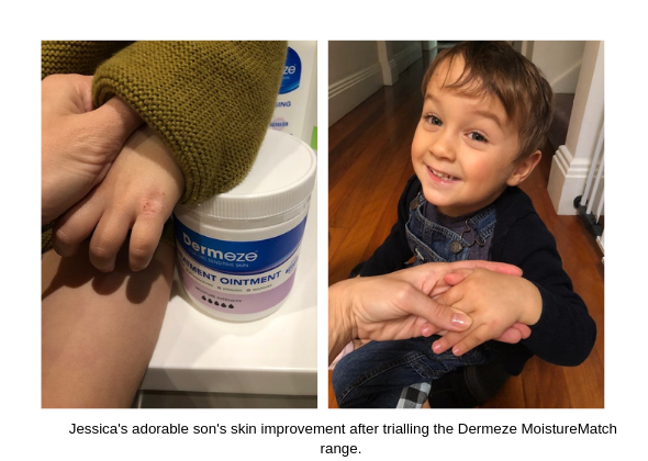 Jessica's adorable son's skin improvement after trialling the Dermeze MoistureMatch range. (2)