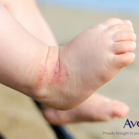 Eczema In Babies; 4 Things You Need To Know