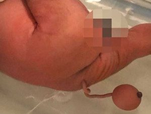 Baby born with tail