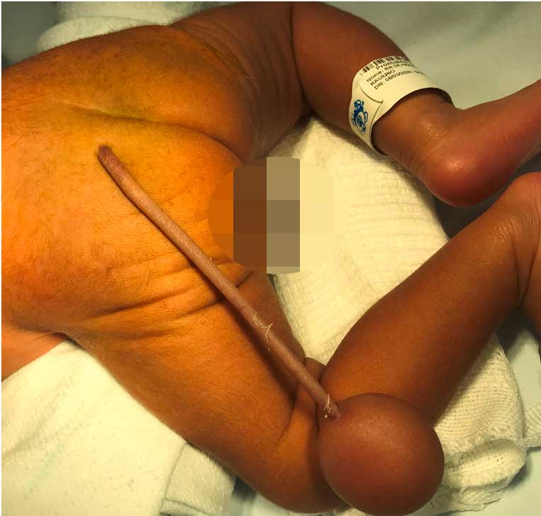 Baby born with human tail