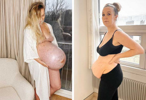 Triplet pregnancy before after belly