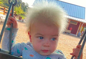 Uncombable Hair Syndrome 3