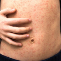 Victoria Records First Measles Case In Two Years