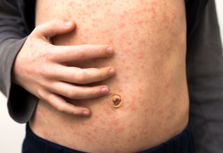 Victoria Records First Measles Case In Two Years