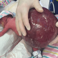 Queensland Baby Born With 2kg Tumour