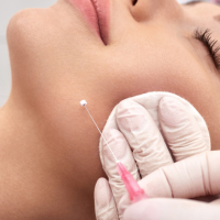 Everything You Need To Know About Thread Lift Treatment