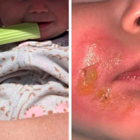 Mum's Warning After Baby Suffers Burns From Eating Celery