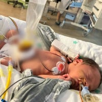 Queensland Baby Born With Stomach Outside His Body