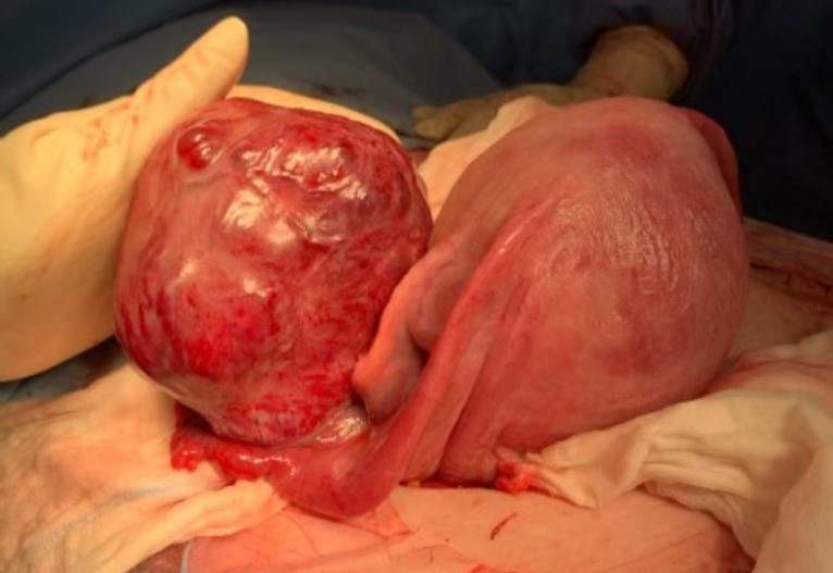 Baby after ovarian tumour