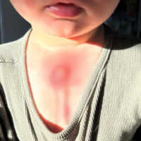 Toddler Suffers Horrific 'Margarita Burn' After Playing Outside